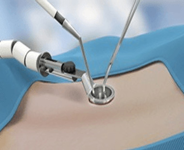 Minimally invasive spine surgery