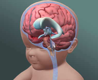 Hydrocephalus (Endoscopic surgery)