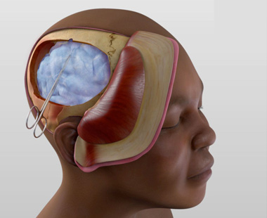 Awake craniotomy with intraoperative monitoring